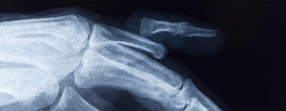 Fracture Stabilization